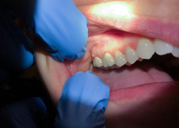 Best Emergency Dental Care for Broken or Chipped Teeth in Lake Mary, FL